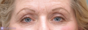 Brow Lift Before and After Pictures in San Diego, CA