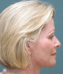 Belladerma Mini Facelift™ Before and After Pictures in San Diego, CA