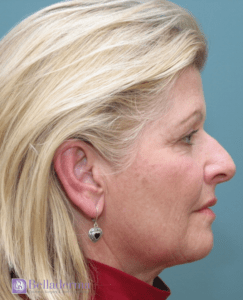 Belladerma Mini Facelift™ Before and After Pictures in San Diego, CA