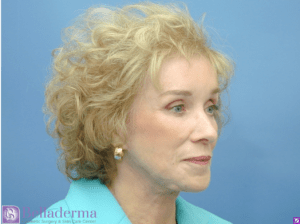 Belladerma Mini Facelift™ Before and After Pictures in San Diego, CA