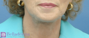 Lip Augmentation Before and After Pictures in San Diego, CA