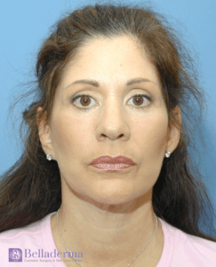 Belladerma Mini Facelift™ Before and After Pictures in San Diego, CA