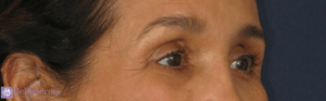 Brow Lift Before and After Pictures in San Diego, CA