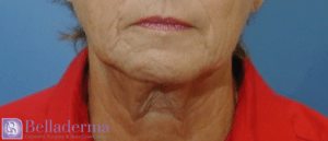 Lip Augmentation Before and After Pictures in San Diego, CA