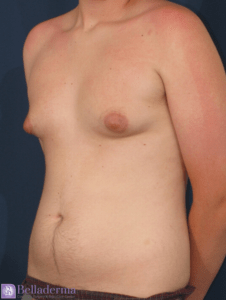 Liposuction Before and After Pictures in San Diego, CA