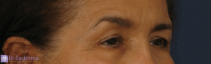 Brow Lift Before and After Pictures in San Diego, CA