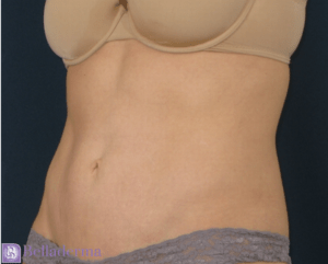 Tummy Tuck Before and After Pictures in San Diego, CA