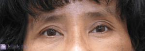 Brow Lift Before and After Pictures in San Diego, CA