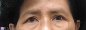 Brow Lift Before and After Pictures in San Diego, CA