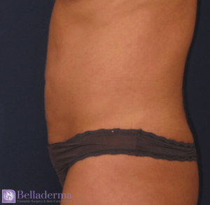 Liposuction Before and After Pictures in San Diego, CA