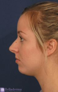 Chin Augmentation Before and After Pictures in San Diego, CA