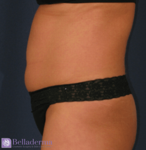 Liposuction Before and After Pictures in San Diego, CA
