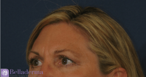 Brow Lift Before and After Pictures in San Diego, CA