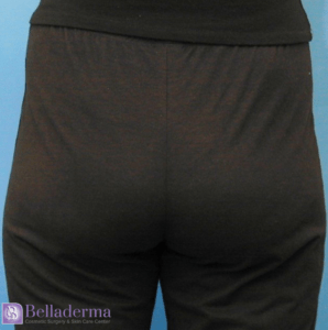 Liposuction Before and After Pictures in San Diego, CA