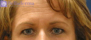 Brow Lift Before and After Pictures in San Diego, CA