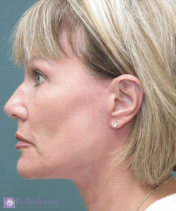 Belladerma Mini Facelift™ Before and After Pictures in San Diego, CA