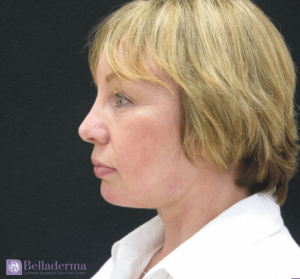 Chin Augmentation Before and After Pictures in San Diego, CA