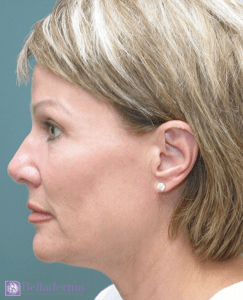Belladerma Mini Facelift™ Before and After Pictures in San Diego, CA