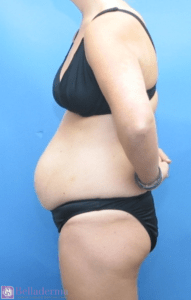 Tummy Tuck Before and After Pictures in San Diego, CA