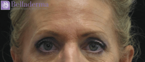 Brow Lift Before and After Pictures in San Diego, CA