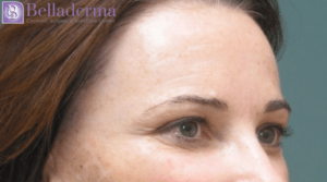 Brow Lift Before and After Pictures in San Diego, CA