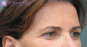 Brow Lift Before and After Pictures in San Diego, CA