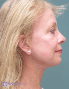 Belladerma Mini Facelift™ Before and After Pictures in San Diego, CA