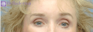 Brow Lift Before and After Pictures in San Diego, CA