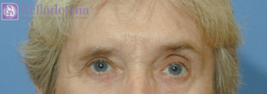 Brow Lift Before and After Pictures in San Diego, CA