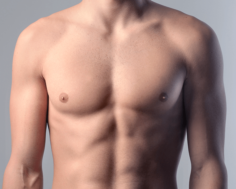 Gynecomastia in San Diego, CA