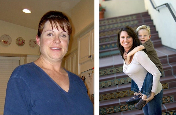 Mommy Makeover Before and After Pictures San Diego, CA
