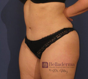 Tummy Tuck Before and After Pictures in San Diego, CA