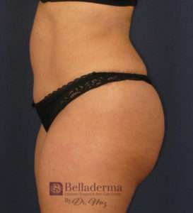 Tummy Tuck Before and After Pictures in San Diego, CA