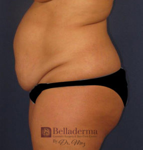 Tummy Tuck Before and After Pictures in San Diego, CA