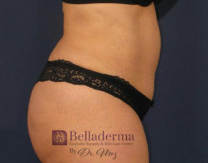 Liposuction Before and After Pictures in San Diego, CA