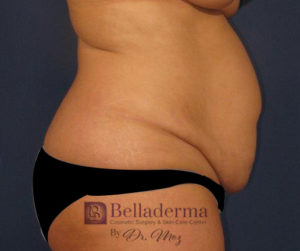 Liposuction Before and After Pictures in San Diego, CA