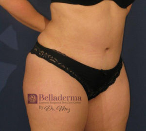 Liposuction Before and After Pictures in San Diego, CA