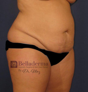 Liposuction Before and After Pictures in San Diego, CA