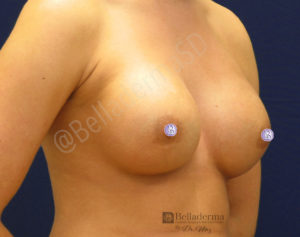 Breast Augmentation Before and After in San Diego, CA