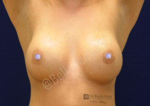 Breast Augmentation Before and After in San Diego, CA