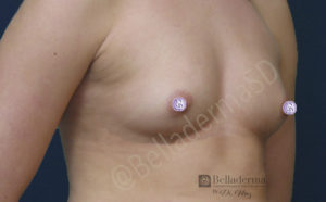 Breast Augmentation Before and After in San Diego, CA