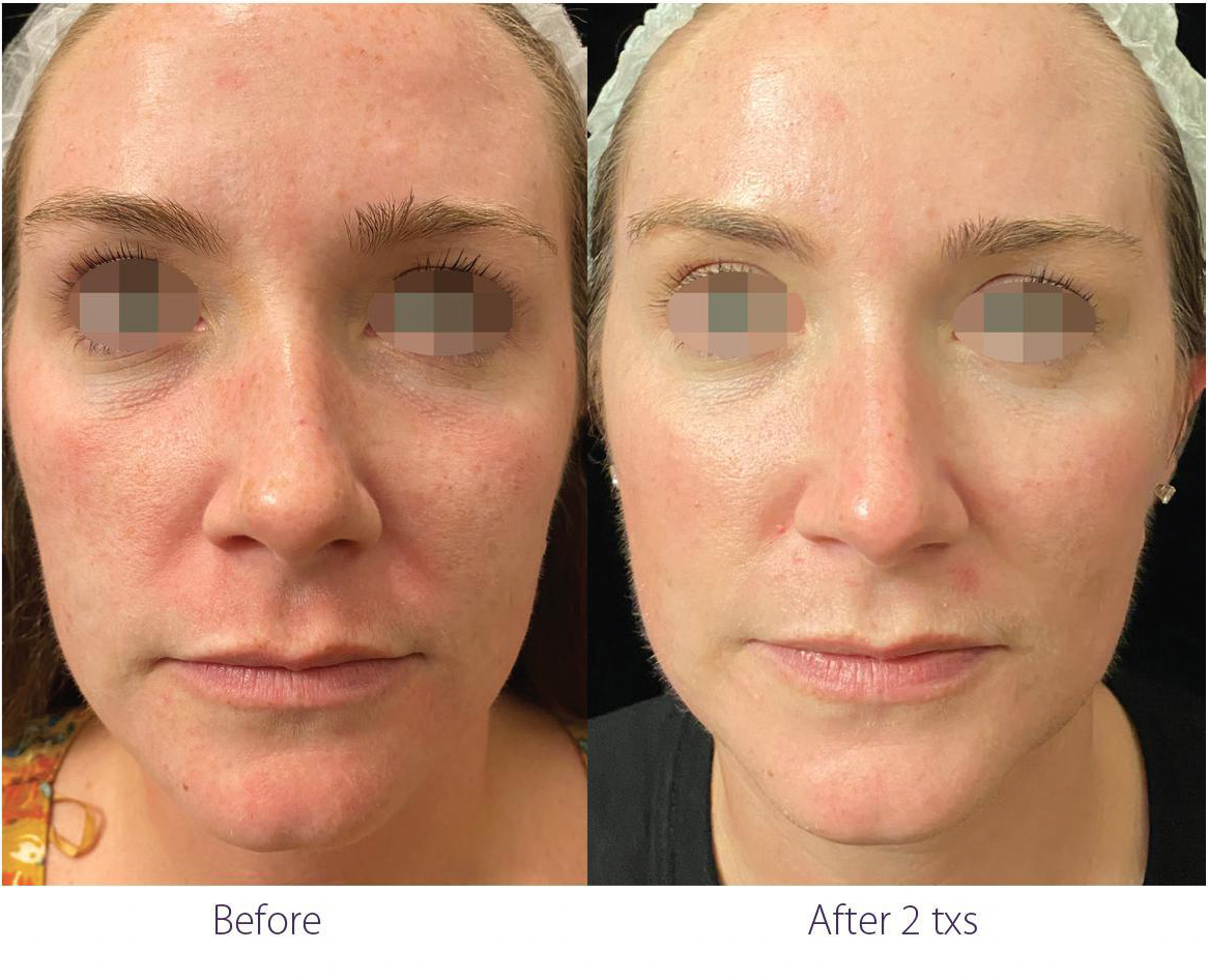 Opus Plasma Before and After Pictures San Diego, CA