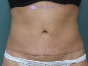 Tummy Tuck Before and After Pictures San Diego, CA