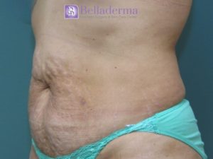 Tummy Tuck Before and After Pictures San Diego, CA