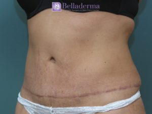 Tummy Tuck Before and After Pictures San Diego, CA