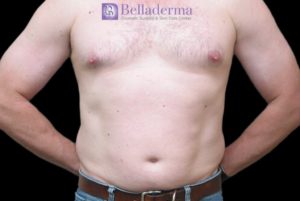 Liposuction Before and After Pictures San Diego, CA