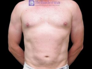 Liposuction Before and After Pictures San Diego, CA