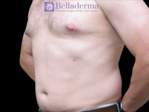 Liposuction Before and After Pictures San Diego, CA