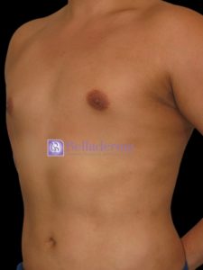 Gynecomastia Before and After Pictures San Diego, CA