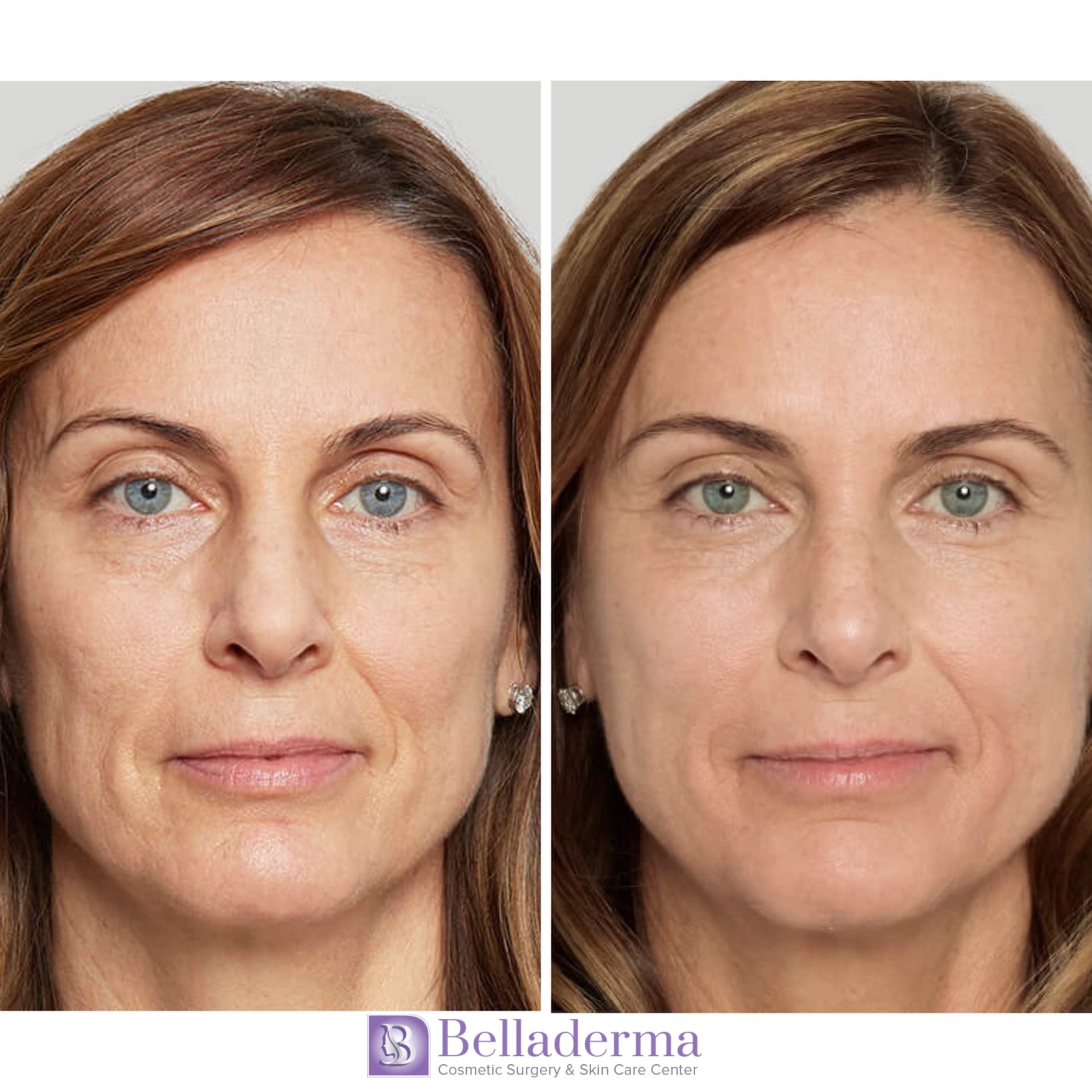 Sculptra® in San Diego, CA